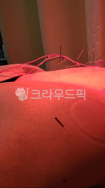 침, 한방, 한의원, 침치료, 부황, 사진,이미지,일러스트,캘리그라피 - 행복한옥수수작가