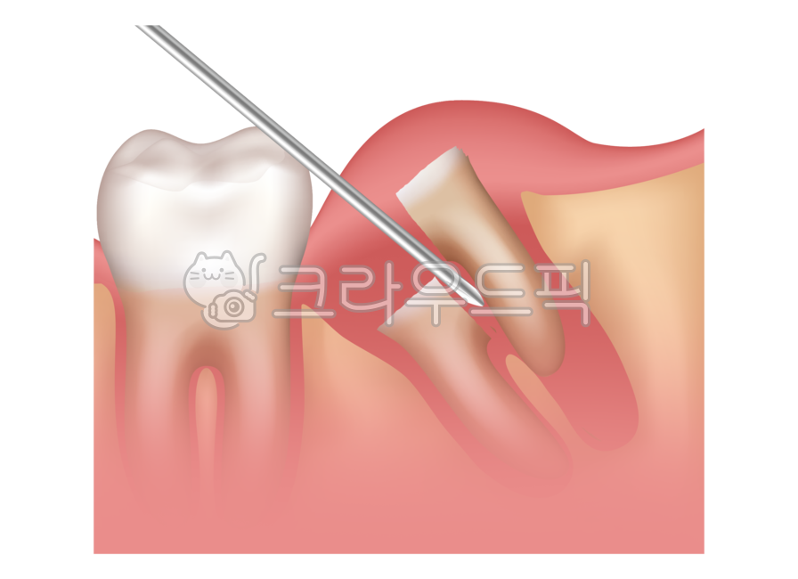 사랑니일러스트,매복사랑니일러스트,치과일러스트,치아일러스트,wisdomtooth,입,mouth,이,teeth,person,bodypart