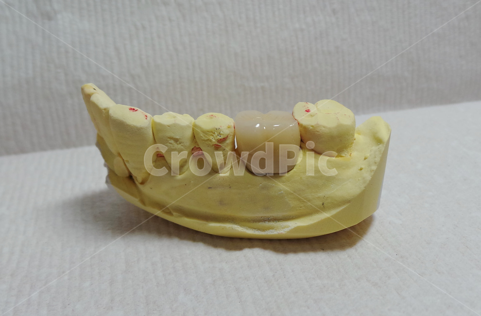 치과,보철,어금니,치과기공사,치아,teeth,보험,porcelain,dental,의료,의학,병원,medical,hospital,clinic