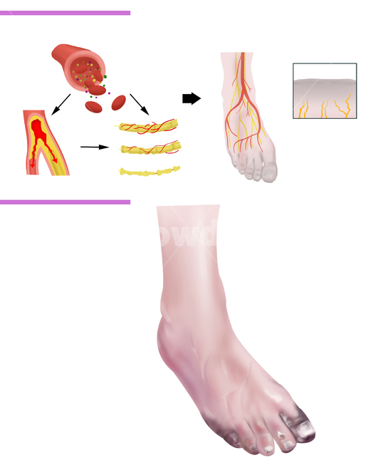 blood vessel,disease,nerve,damaged,Medical illustration,diabetes complications,diabetes,diabetic family
