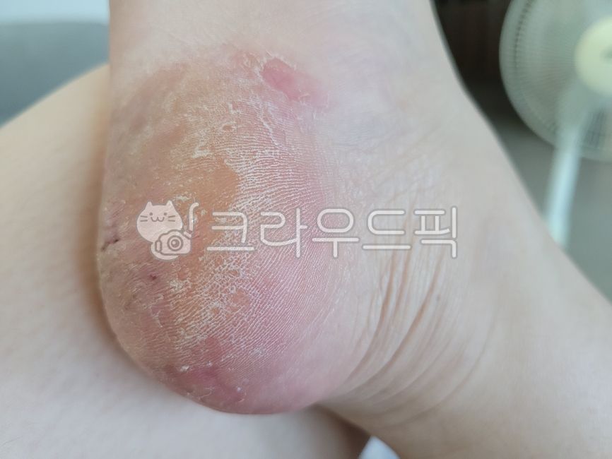 sole,skin,dead skin cells on the soles of the feet,calluses on the soles of the feet,corneous,calluses