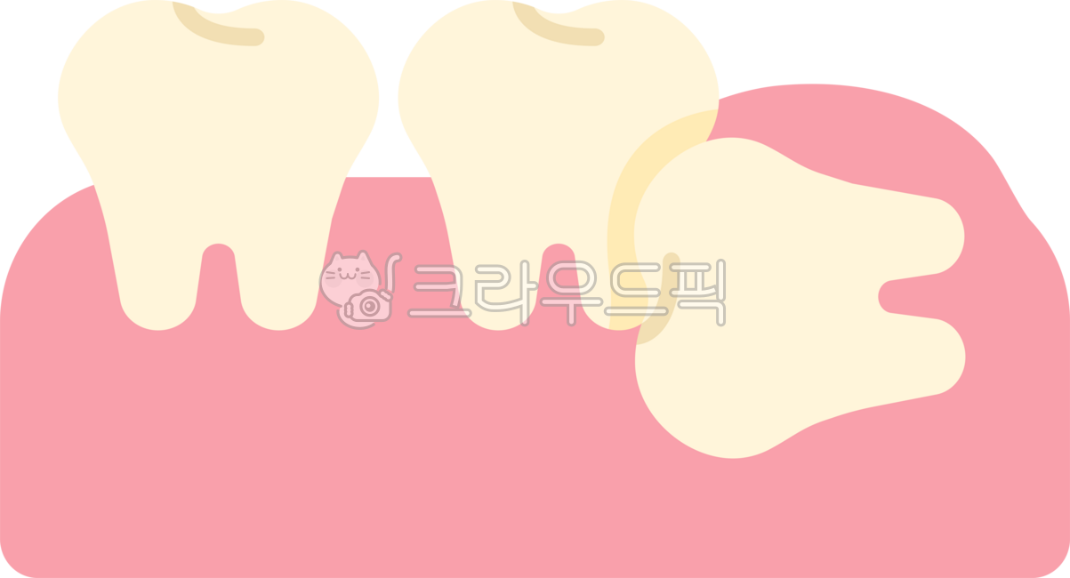 Impacted wisdom tooth,wisdom tooth,wisdom tooth extraction,wisdom tooth extraction,wisdom tooth pain,extraction,wisdom tooth rash,back molar,molar,wisdom tooth removal,dentistry,teeth,teeth,this,wisdomtooth,dental,dentist,tooth,teeth,gu