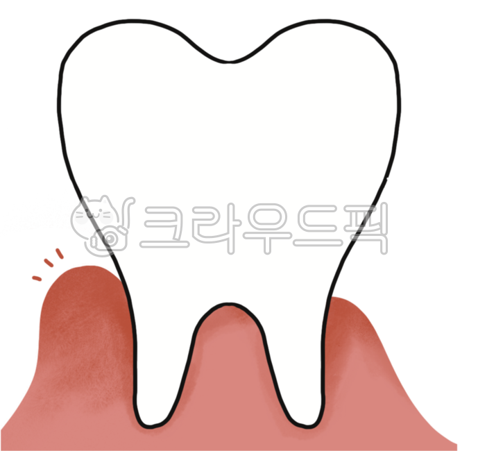 gingivitis,Dentist,Gum illustration,porketdepth,dental disease,periodontal disease,gingiva,teeth,Tooth illustration,tartar,tooth root,dental treatment,Periodontal disease symptoms,gum disease,Subperiodontal,periodontal injury,periddontitis,periodontitis,o