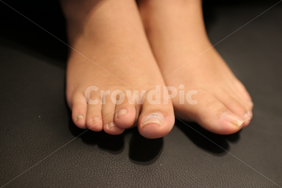 발톱,파고드는발톱,발톱교정,교정기,교정,발톱관리,패디,패디큐어,발,발가락,발끝,사람,인물,인간,human,person,신체일부,몸,body