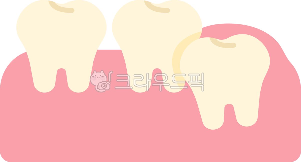 Impacted wisdom tooth,wisdom tooth,wisdom tooth extraction,wisdom tooth extraction,wisdom tooth pain,extraction,wisdom tooth rash,back molar,molar,wisdom tooth removal,dentistry,teeth,teeth,this,wisdomtooth,dental,dentist,tooth,teeth,gu