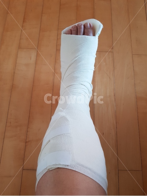 골절,기브스,반기브스,의료,응급실,다리골절,발가락골절,분쇄골절,의료실비보험,치료,병원,의사,환자,사람,인물,인간,human,person,신체일부,몸,body,의료,의학,병원,medical,hospital,clinic