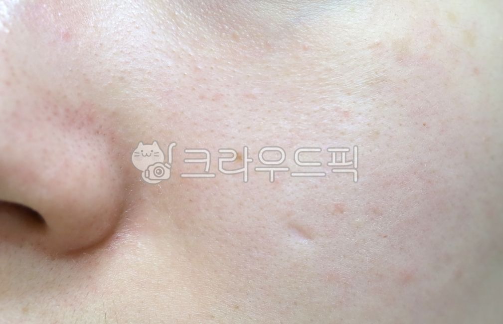 skin care,beauty,cheek,facial flushing,skin,dot,fine wrinkles,Wrinkle care,womans skin,woman face,face,face closeup,closeup,Sensitive,inattention,flushing,sensitivity,female