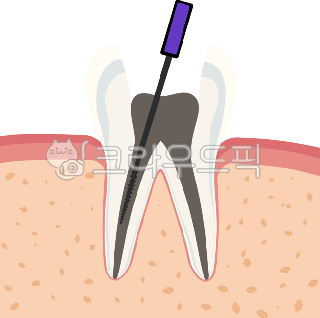 Molar,cavity,root canal,tooth,dentistry,inflammation,crown,inlay,resin,cervical area,abrasion,gums,periodontology