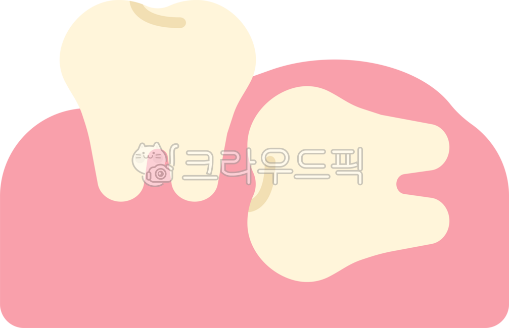 매복사랑니,사랑니,사랑니발치,사랑니추출,사랑니통증,발치,사랑니발진,뒷어금니,어금니,사랑니제거,치과,이빨,치아,이,wisdomtooth,dental,dentist,tooth,teeth,잇몸,치과치료,충치치료