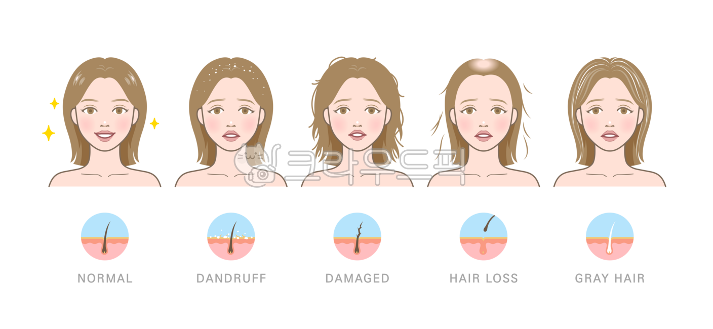 머리,머리카락,모발,머릿결,빠짐,탈모,원형탈모,머리빠짐,풍성한,뺵빽한,머리숱,숱,흰머리,새치,노화,볼륨,문제,손상된,손상모,갈라짐,갈라진,푸석푸석한,푸석한,부스스한,비듬,각질,여자,여성,사람,인물,모델,얼굴,캐릭터,미용,관리,일러스트,비교,세트,예쁜