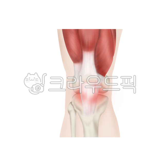 질환,메디컬,일러스트,설명,슬개건염,무릎,염증,의료,의학,병원,medical,hospital,clinic