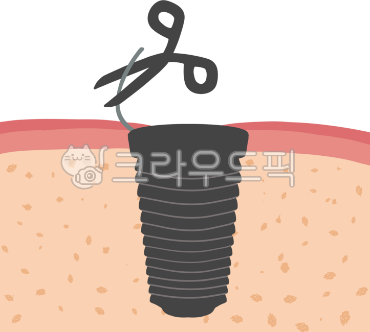 임플란트,크라운,치아,치과,브릿지,치료,잇몸,실밥,잇몸염증,치주,치조골,이차,어금니,지르코니아