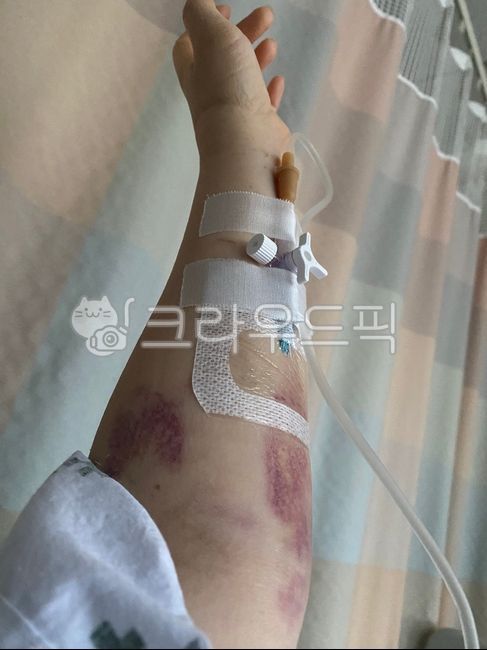 멍,링거,주사,항생제,bodypart,팔,수술후,부작용,아픔,피멍,병원,신체부위,손,영양제,수술