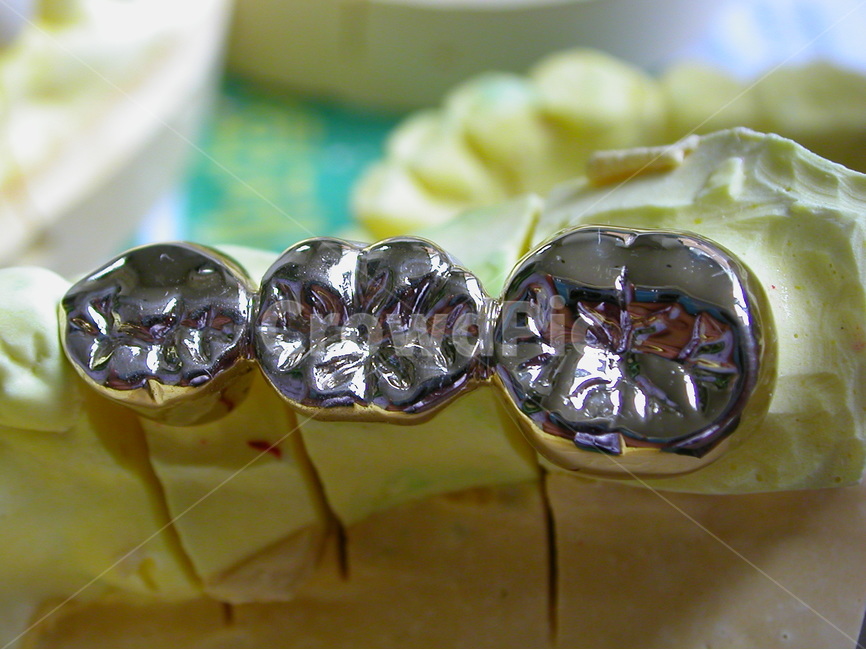 치과,금니,보철,의료,브릿지,gold,치과기공,이빨,치아,dental,크라운,crown,의료,의학,병원,medical,hospital,clinic,사물,물건,오브젝트,thing,object,matter