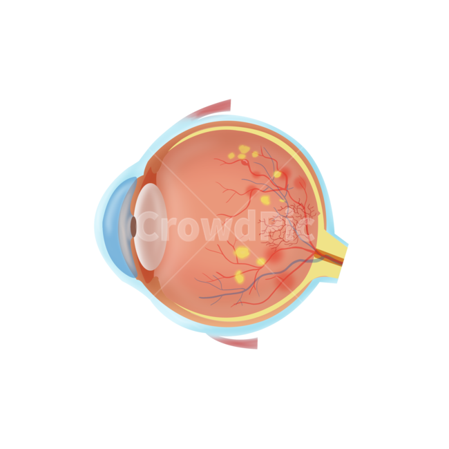 diabetic complications,medical,retinal degeneration,disease,complications,png,medical illustration,eye,condition,Medical,illustration,ophthalmology,diabetes