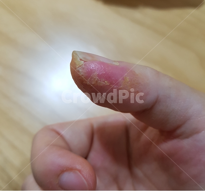 엄지,염증,상처,연고,새살,손,finger,손가락,세균,사람,신체일부,몸,body