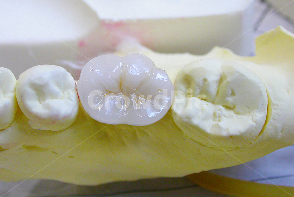 치과,의료,어금니,보철,임플란트,도자기,성형,덴탈,치과기공,치아,이빨,implant,dental,의료,의학,병원,medical,hospital,clinic
