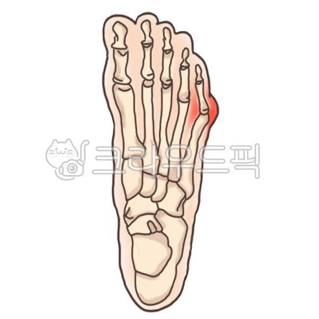 새끼발가락,발가락,정형외과,관절,소건막,소건막류,족부,발,발모양,bunionette,foot,toe,hospital,medical,병,질환,발모양질환,통증,치료,신체부위,신체,사람,인체