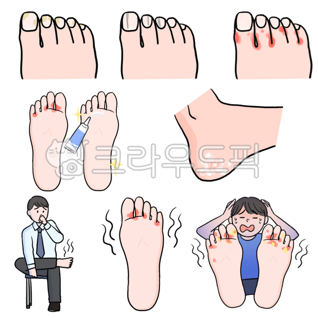 무좀,발가락무좀,발톱무좀,피부과,피부질환,피부과질환,각질,발,발가락,발바닥,발바닥무좀,발냄새,무좀증상,무좀각질,무좀치료,무좀관리,피부과질환관리,발톱검은줄,발가락무좀치료,발가락무좀관리,발냄새무좀