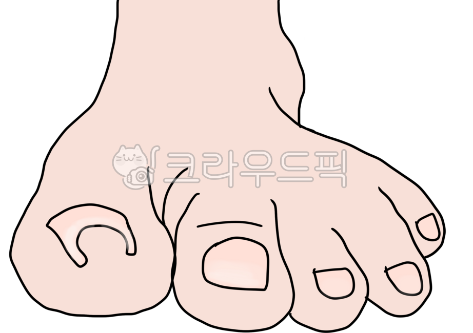 Ingrown toenail,big toe,ingrown toenail,foot,toe,resistant toenail,toenail,foot disease,toe pain,toenail care,toenail disease,toenail damage,health care,foot care method,toenail surgery,toenail,toenail correction,toenail inflammation,foo