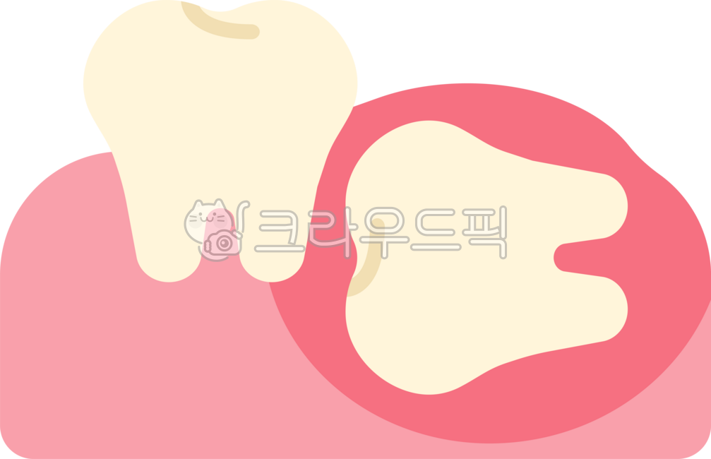 Impacted wisdom tooth,wisdom tooth,wisdom tooth extraction,wisdom tooth extraction,wisdom tooth pain,extraction,wisdom tooth rash,back molar,molar,wisdom tooth removal,dentistry,teeth,teeth,this,wisdomtooth,dental,dentist,tooth,teeth,gu