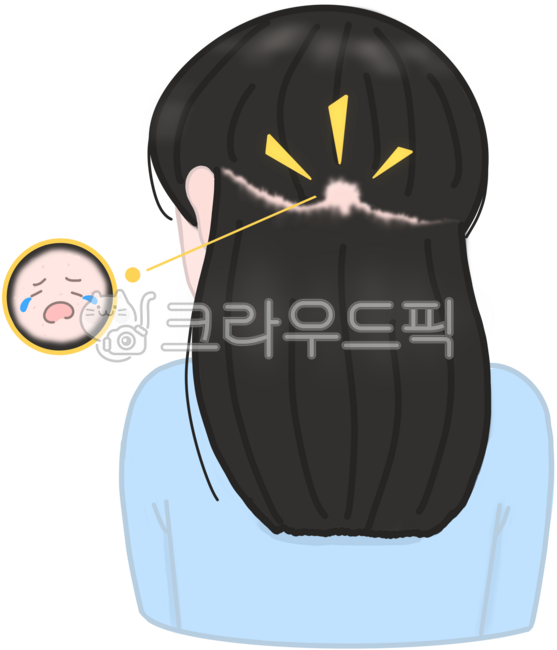 여성탈모,원형탈모,동전탈모,탈모치료,탈모,머리카락,모발빠짐,노화,관리,두피관리,두피,뷰티,케어,대머리,탈모치료제,탈모진행,탈모고민,스트레스