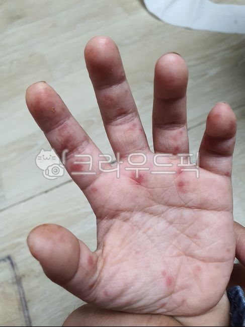 수족구병,피부질환,손,피부병,아기손