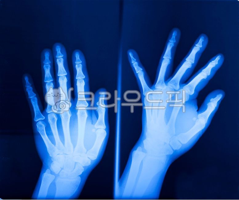 에스레이,영상필름,손뼈사진,손가락뼈,xray