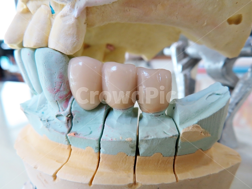 teeth,mouth,치과,임플란트,브릿지,보철,수복,치아,포셀린,석고,구강모형,치의학,의료,보건,구강보건,implant,수술,치과의원,치과병원,치과의사,hospital,treatment,dental,dentistry,bridge,의료,의학,병원,medical,hospital,clinic