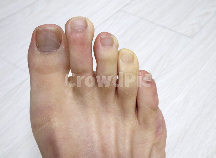 레이노병,레이노증후군,혈관,발가락,발,추위,의학,피부,raynaud,수족냉증,Raynaud,신체일부,몸,body