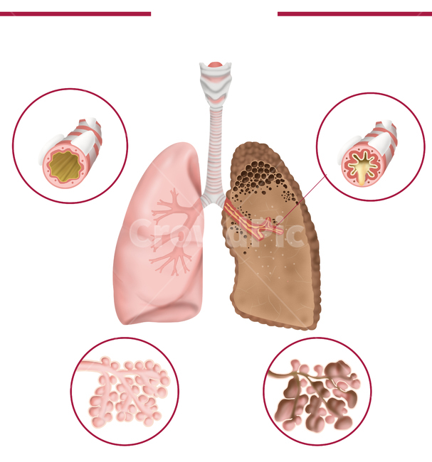 폐질환,만성,폐쇄성,copd,질환,질병,메디컬일러스트,의료,의학,병원,medical,hospital,clinic,그래픽,일러스트레이션,graphic,illustration