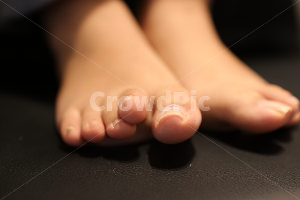 발톱,파고드는발톱,발톱교정,교정기,교정,발톱관리,패디,패디큐어,발,발가락,발끝