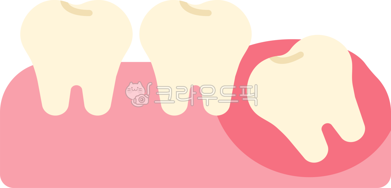 매복사랑니,사랑니,사랑니발치,사랑니추출,사랑니통증,발치,사랑니발진,뒷어금니,어금니,사랑니제거,치과,이빨,치아,이,wisdomtooth,dental,dentist,tooth,teeth,잇몸,치과치료,충치치료