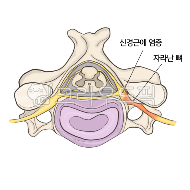 thecervicalvertebral, 경추, 경추협착증, 협착증, 신경외과, 사진,이미지,일러스트,캘리그라피 - Naksend11작가