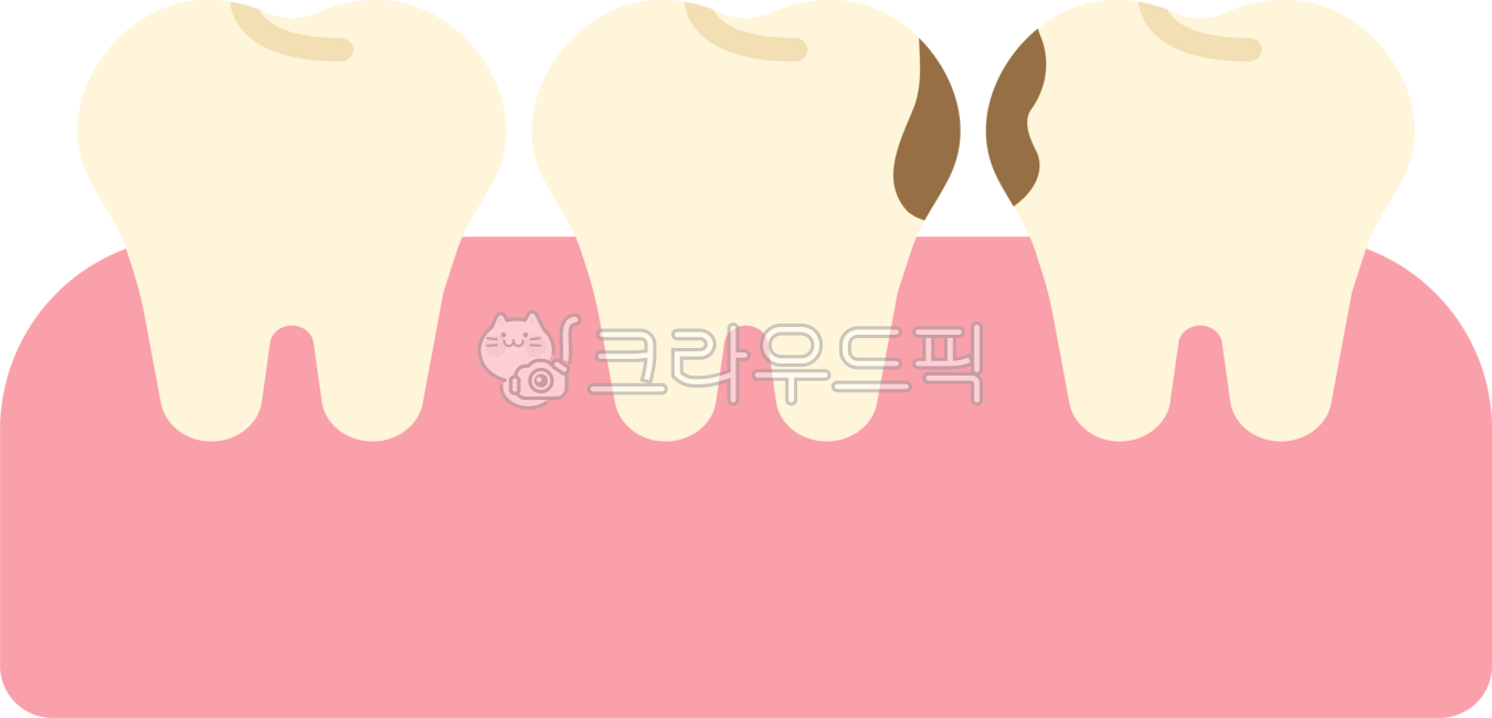 Cavity between teeth,cavity between teeth,cavity between teeth,cavity,upper limit,rotten tooth,shallow cavity,tooth,teeth,dentistry,rotten tooth,rotten tooth,cavity illustration,cavity model,cavity illustration,dental treatment,root canal 