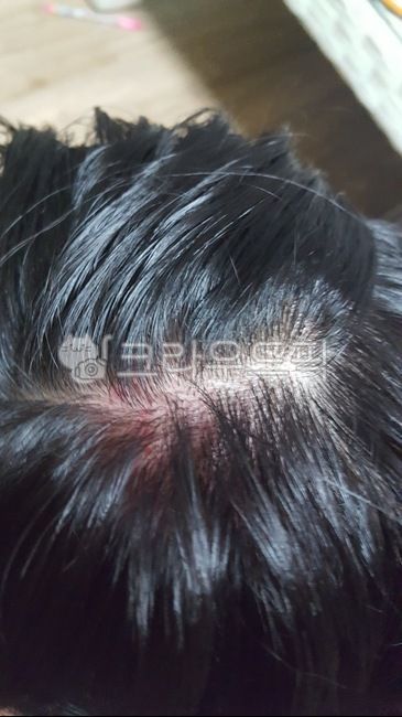 head bruise,head injury,bruise