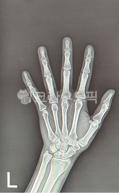 xray,엑스레이,왼손,손가락,finger,lefthand,left,뼈,bone,병원,hospital,왼손엑스레이