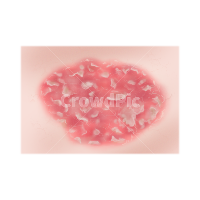 메디컬,medical,png,일러스트,습진,각질,병증,피부병,질환,누끼,remove background