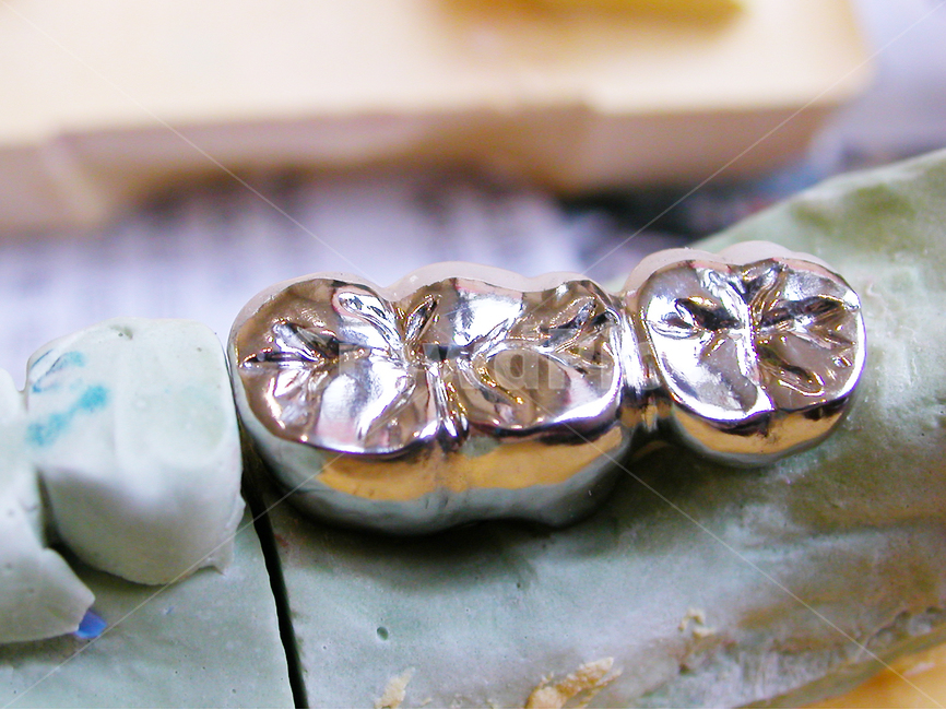 치과,의료,보철,임플란트,implant,치과기공사,기공,덴탈,임플랜트,수술,dental,의료,의학,병원,medical,hospital,clinic,사물,물건,오브젝트,thing,object,matter