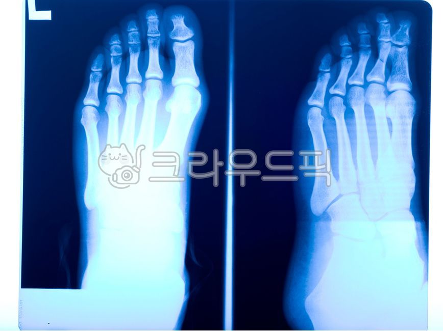 엑스레이,xray,발뼈,발가락뼈,의료영상,의료영상필름