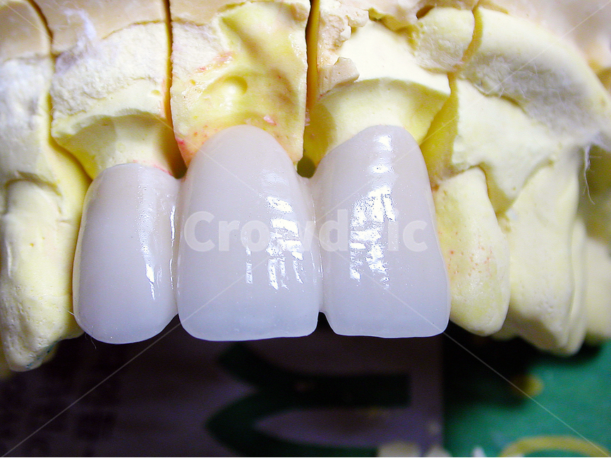 의료,치과,앞니,보철,성형,도자기,세라믹,dental,치아,이빨,석고,치과기공,의료,의학,병원,medical,hospital,clinic,사물,물건,오브젝트,thing,object,matter
