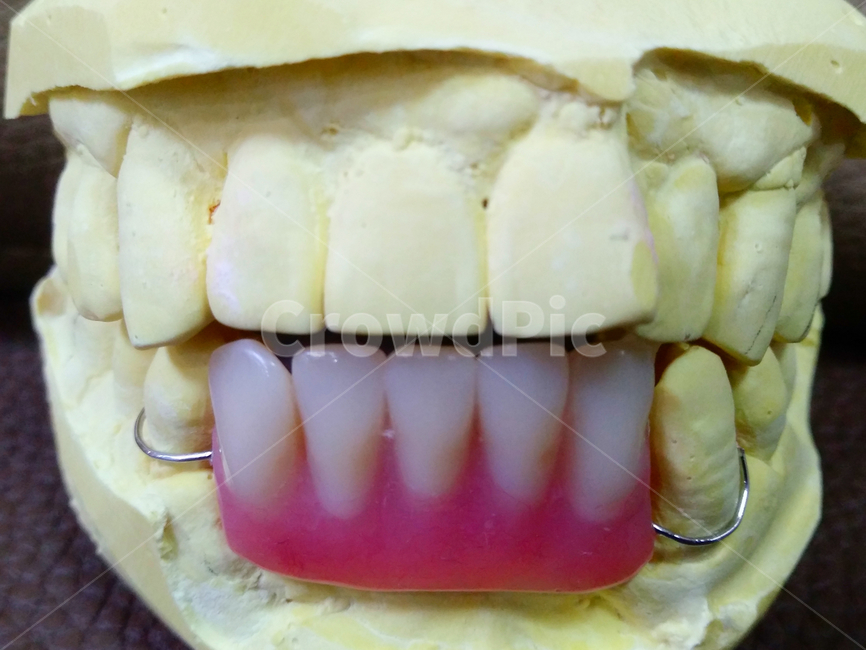 mouth,입,teeth,이,치과,임시치아,임시보철,핑크레진,레진치아,와이어,치과병원,치과의원,치의학,구강보건,의료,dental,dentist,dentistry,healthcare,medical,hospital,resin,치과의사,wire,pink,석고,모형