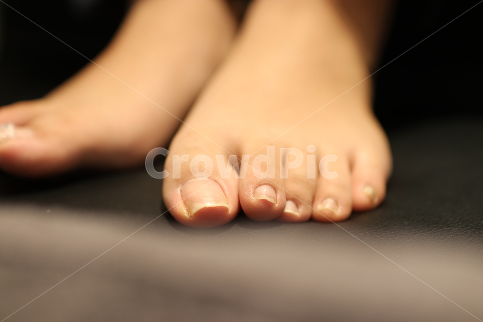 발톱,파고드는발톱,발톱교정,교정기,교정,발톱관리,패디,패디큐어,발,발가락,발끝