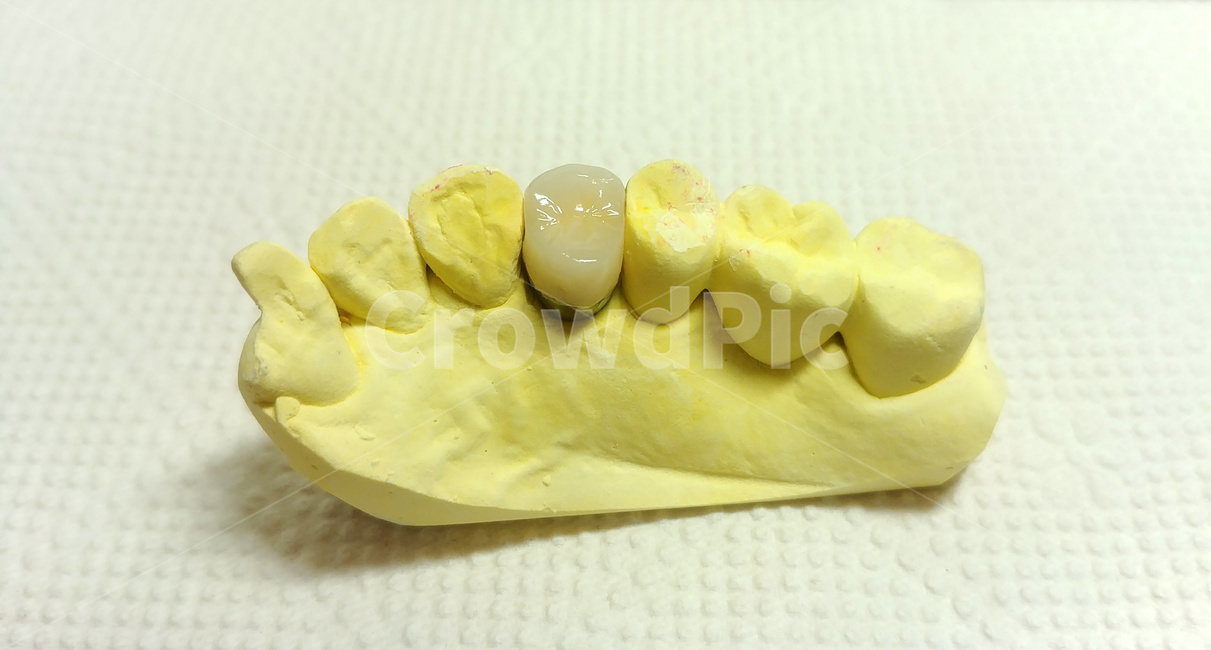 치과,보철,치아,치과기공사,dental,소구치,인공치아,이빨
