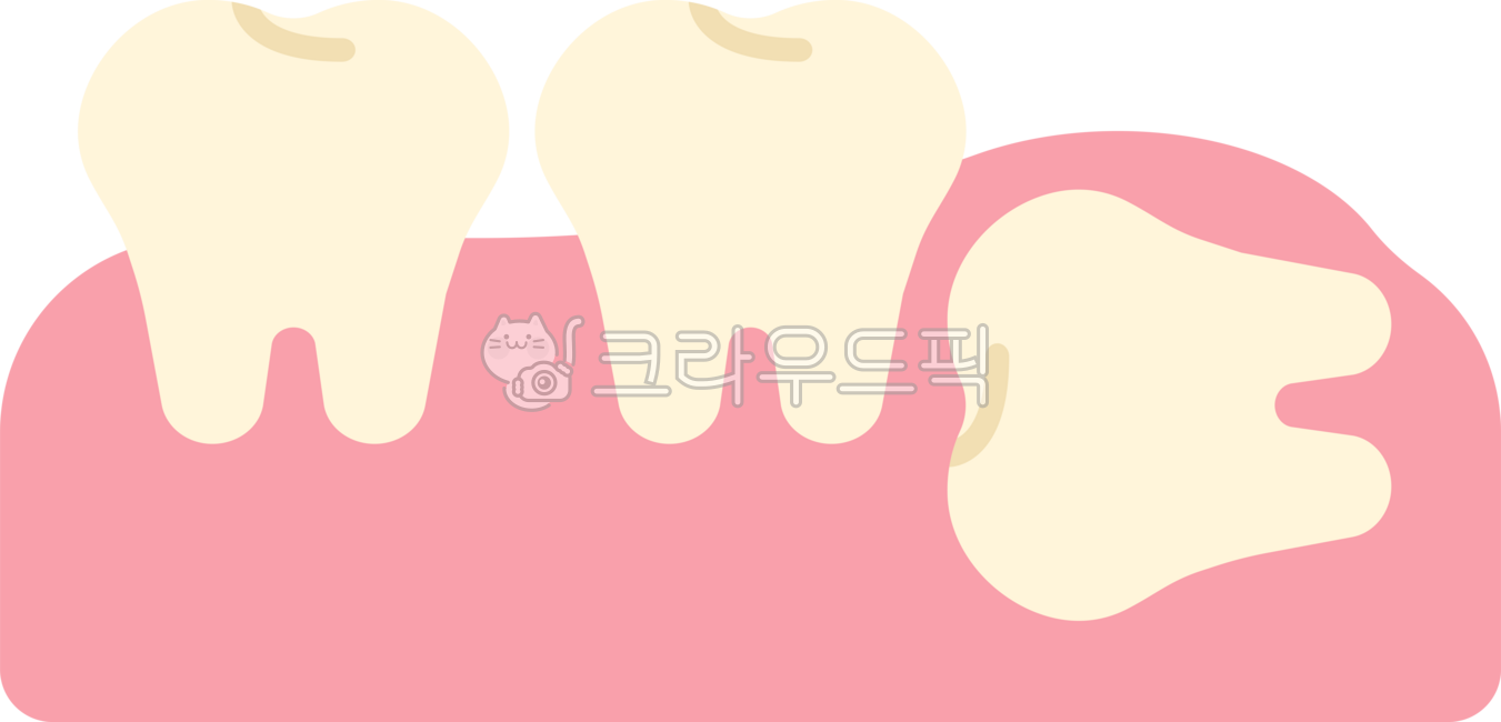 매복사랑니,사랑니,사랑니발치,사랑니추출,사랑니통증,발치,사랑니발진,뒷어금니,어금니,사랑니제거,치과,이빨,치아,이,wisdomtooth,dental,dentist,tooth,teeth,잇몸,치과치료,충치치료