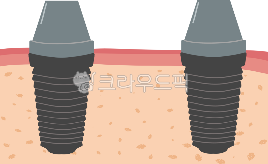 Implants,crowns,teeth,dentistry,bridges,treatment,gums,stitches,gum inflammation,periodontal disease,alveolar bone,secondary,molars,zirconia