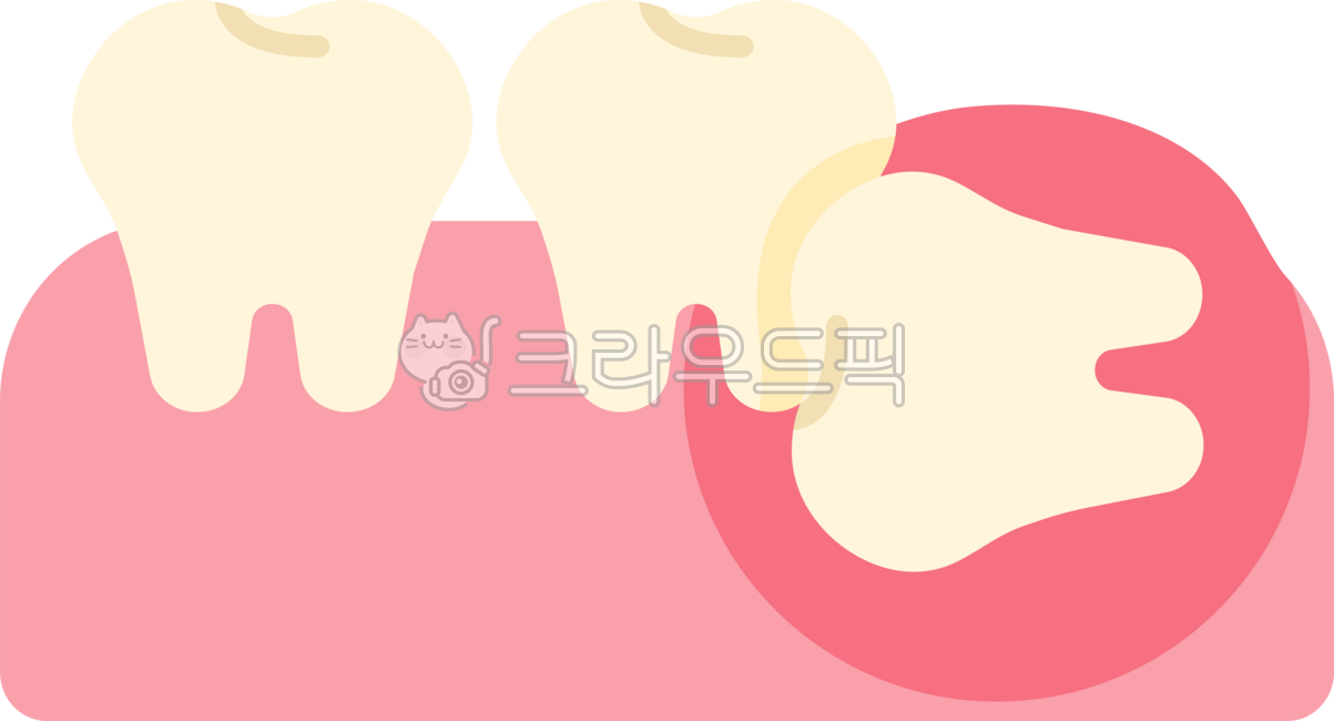Impacted wisdom tooth,wisdom tooth,wisdom tooth extraction,wisdom tooth extraction,wisdom tooth pain,extraction,wisdom tooth rash,back molar,molar,wisdom tooth removal,dentistry,teeth,teeth,this,wisdomtooth,dental,dentist,tooth,teeth,gu