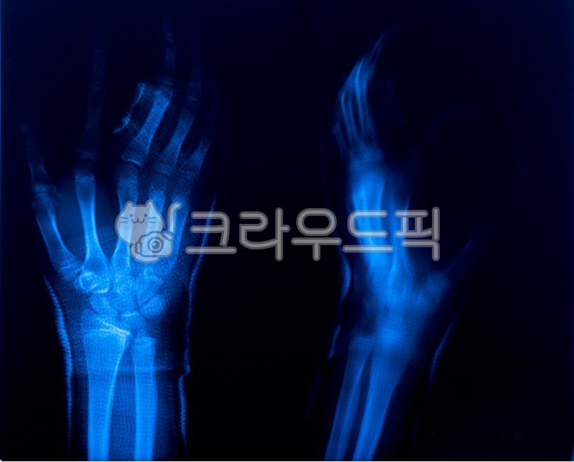 에스레이,영상필름,팔목뼈필름,손가락필름,xray