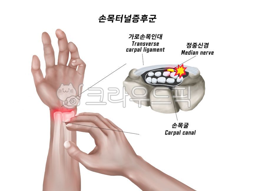 손목터널증후군,손목뼈,손목통증,메디컬일러스트,정형외과,의료