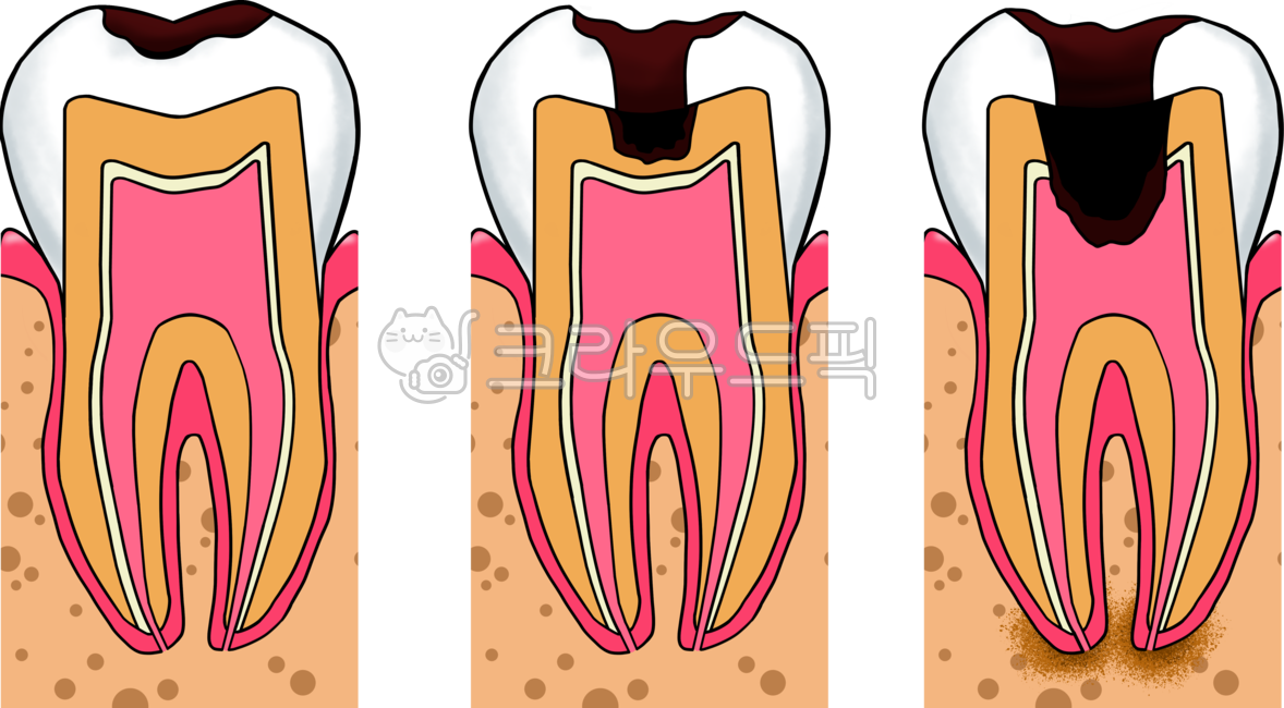 신경치료,이빨,치아,충치,치과,치료